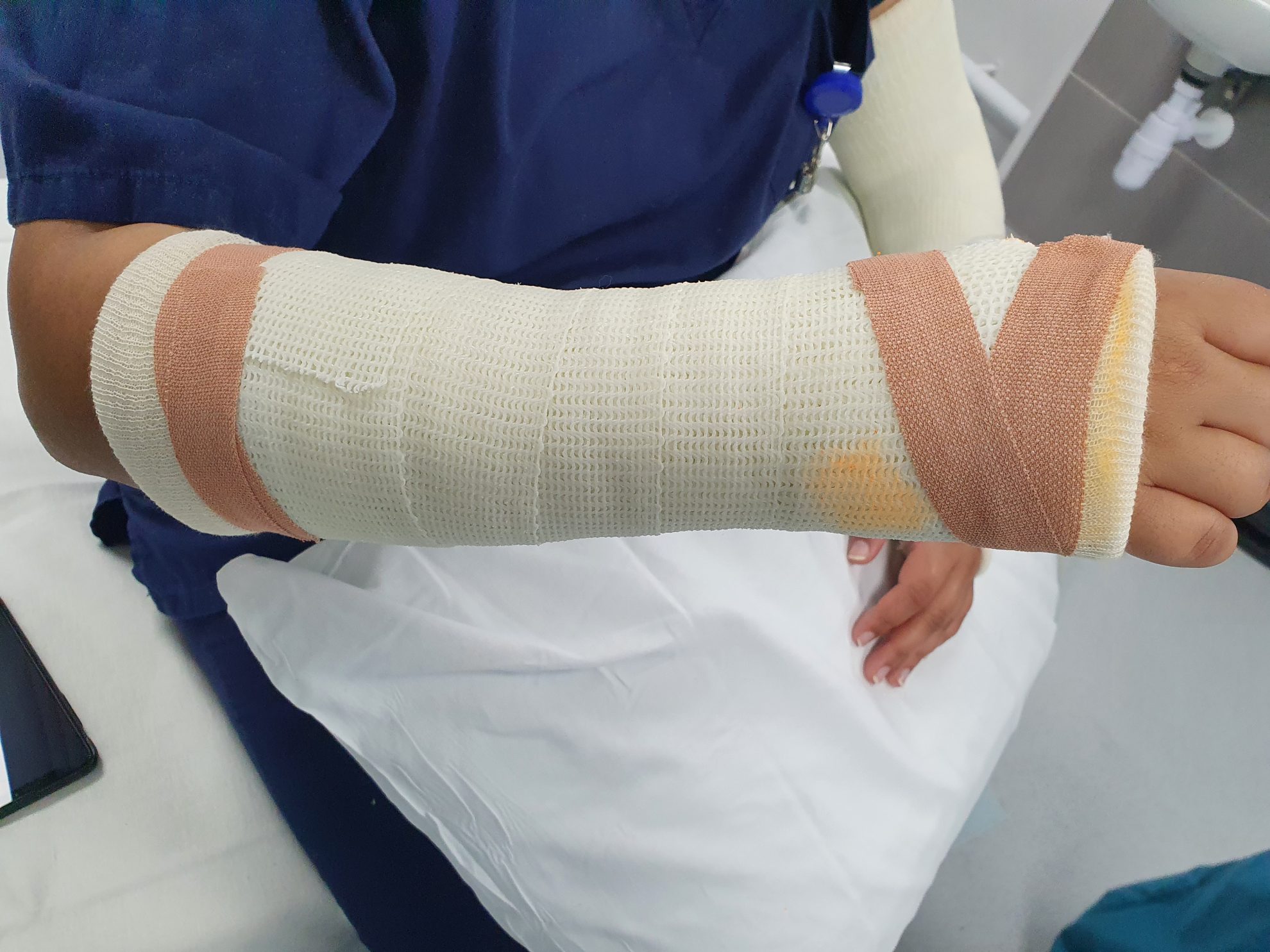 Forearm cast plaster room