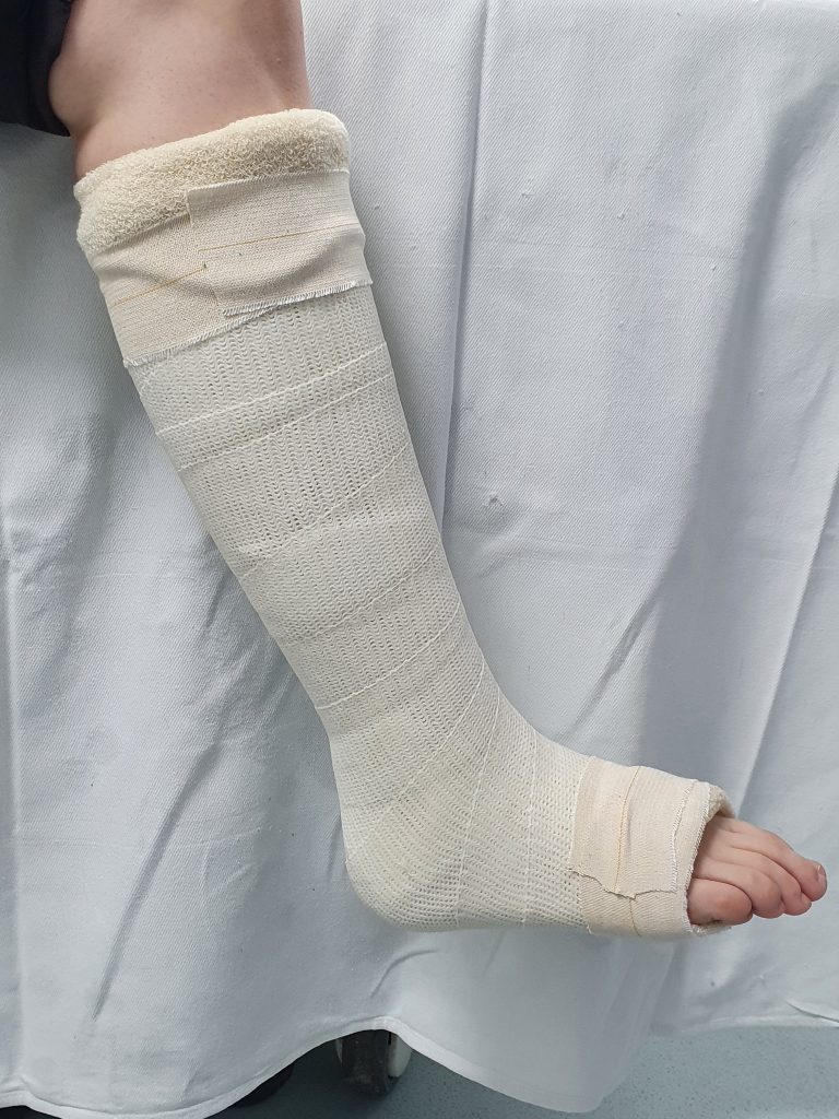 Picture of cast from calf till the mid of the feet