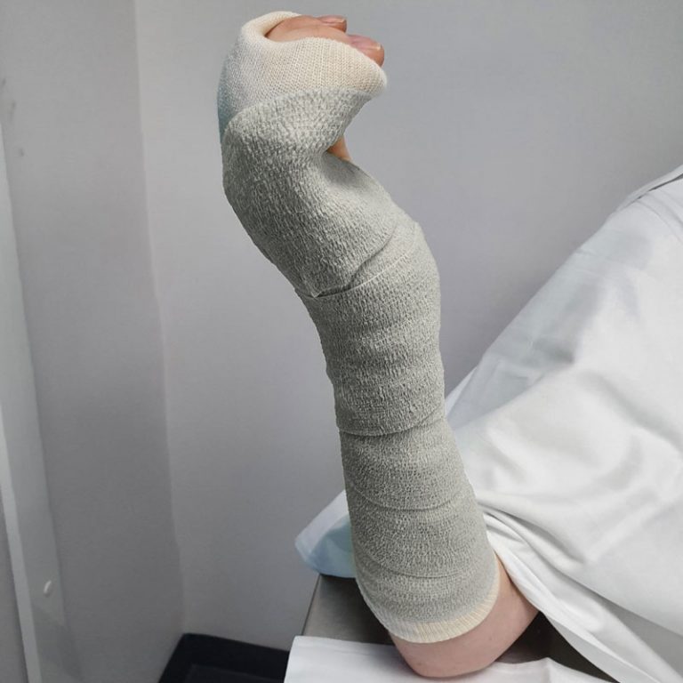 What Is An Ulnar Gutter Splint at Carl Goddard blog