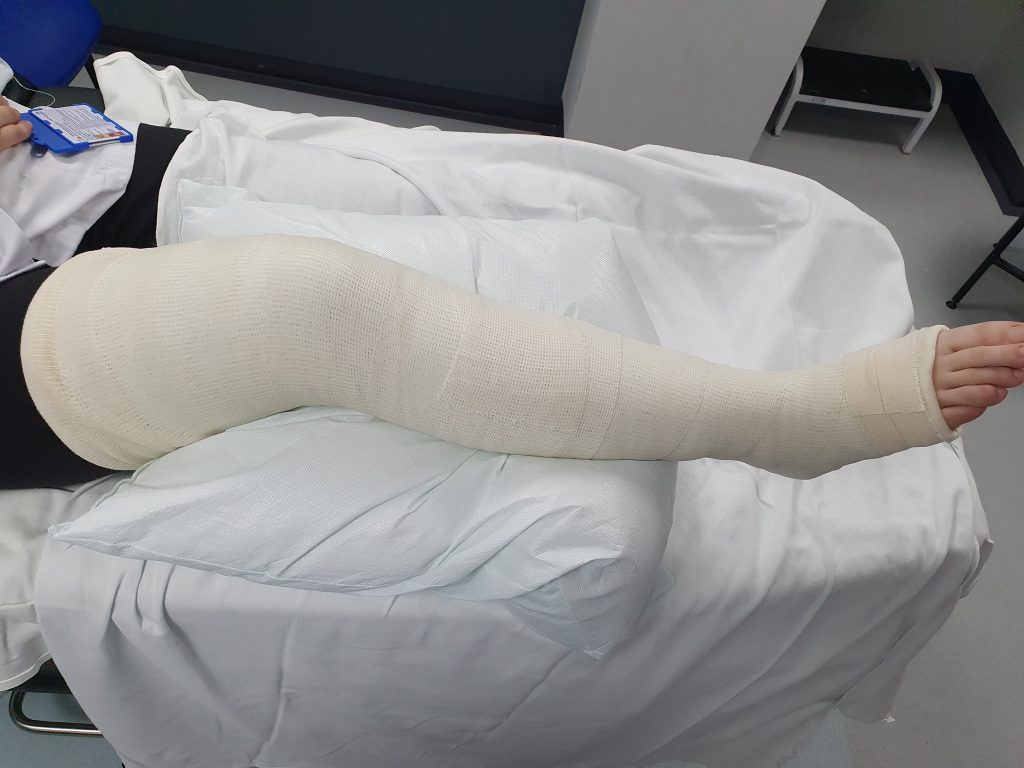 picture of cast from thigh till mid of the foot