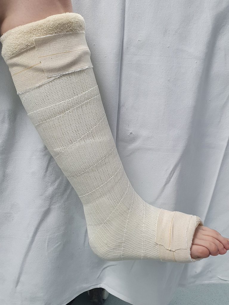 Picture of cast from calf till the mid of the feet