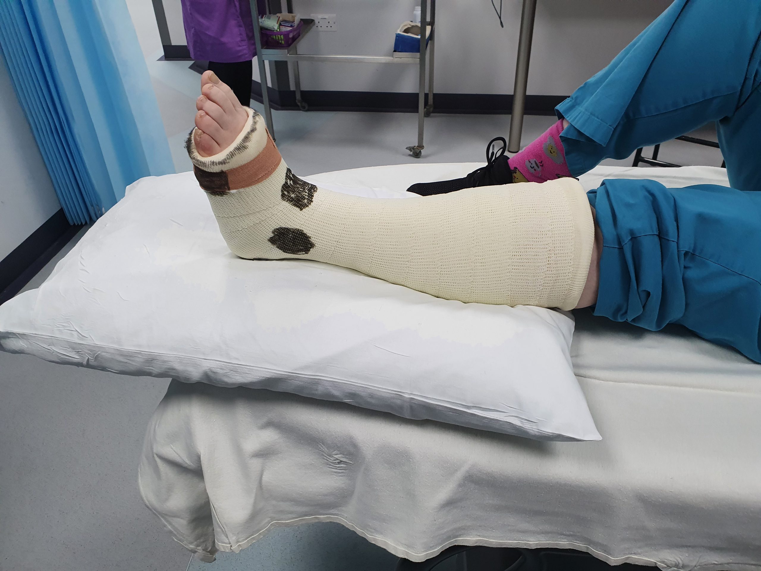 Picture of cast from calf till the mid of the feet