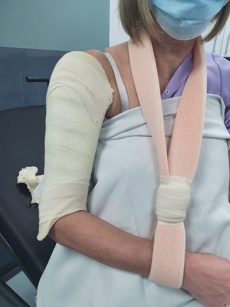 hanging arm cast for humerus fracture